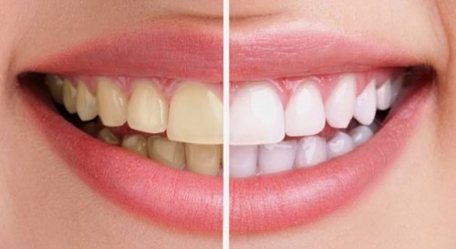 Tẩy trắng răng 1 lần tại nha khoa là bao nhiêu ? Nên tẩy trắng đối với nhưng trường hợp răng như thế nào ?