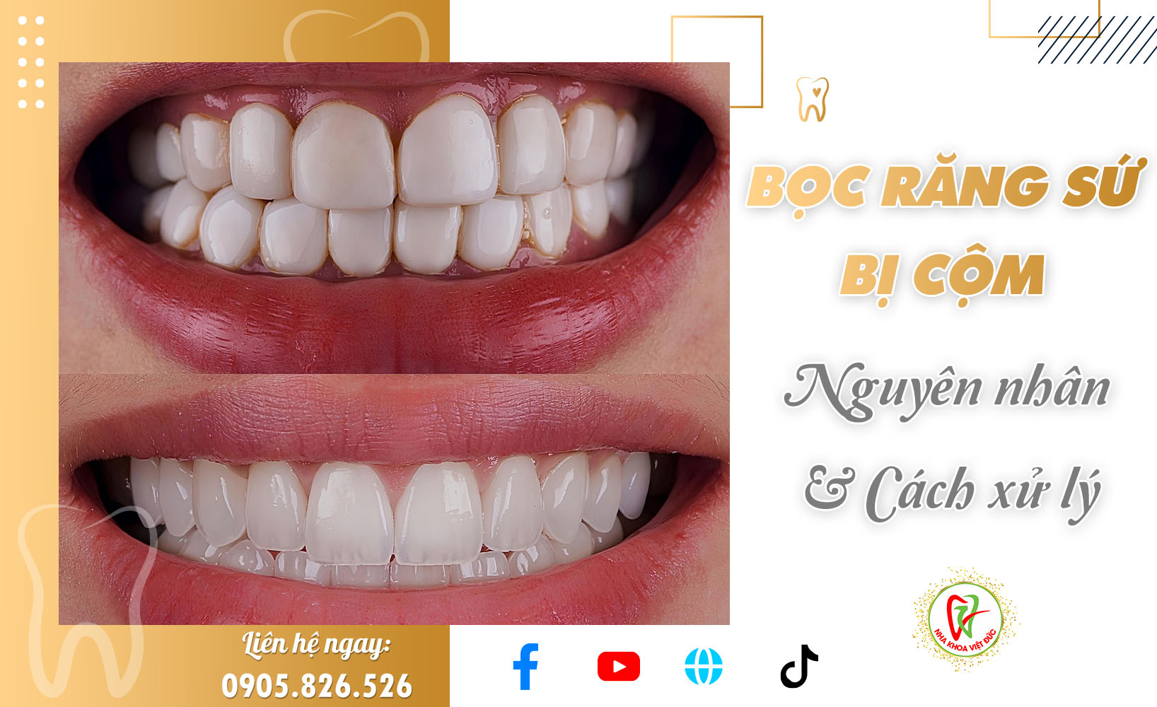 BỌC RĂNG SỨ BỊ CỘM – NGUYÊN NHÂN VÀ CÁCH XỬ LÝ