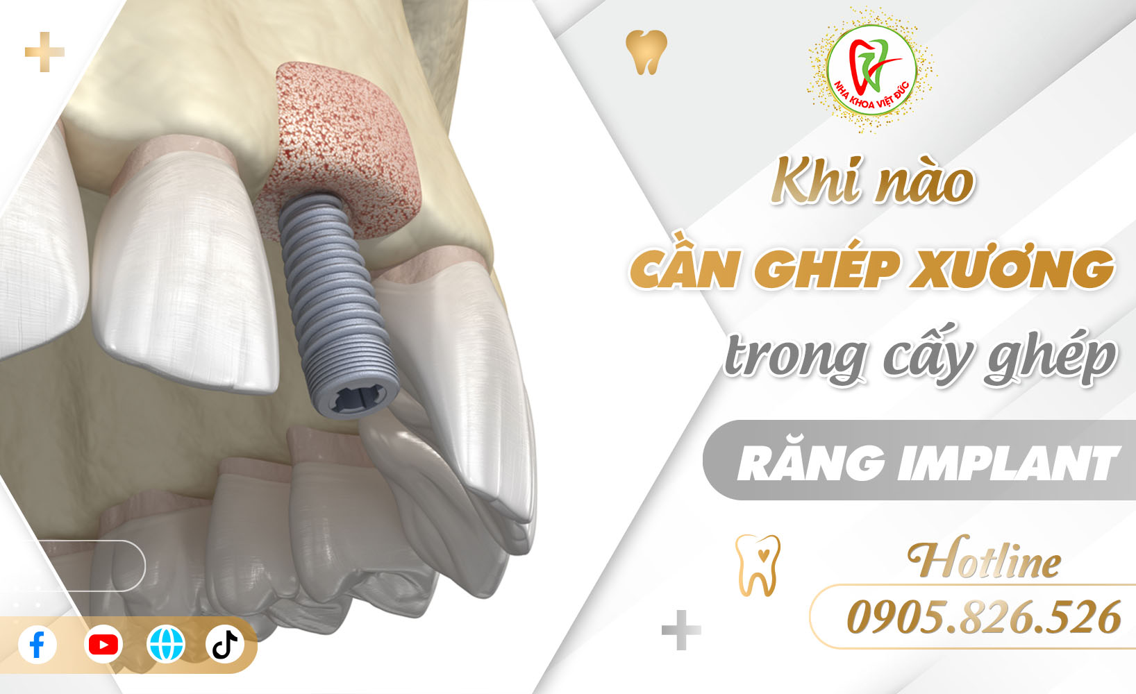 KHI NÀO CẦN GHÉP XƯƠNG TRONG CẤY GHÉP RĂNG IMPLANT?