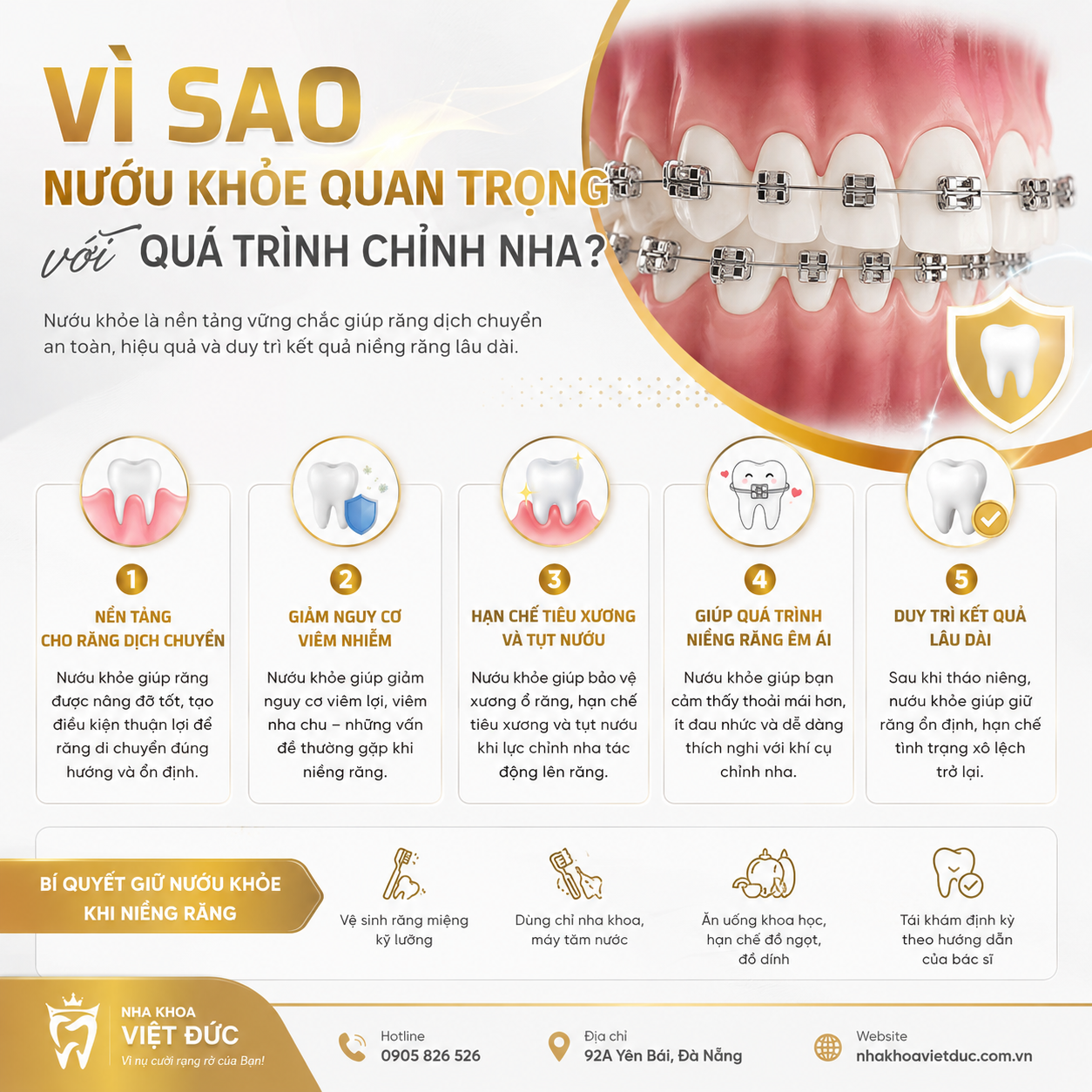 Minh họa hỗ trợ: Nướu đang viêm có nên niềng răng không?
