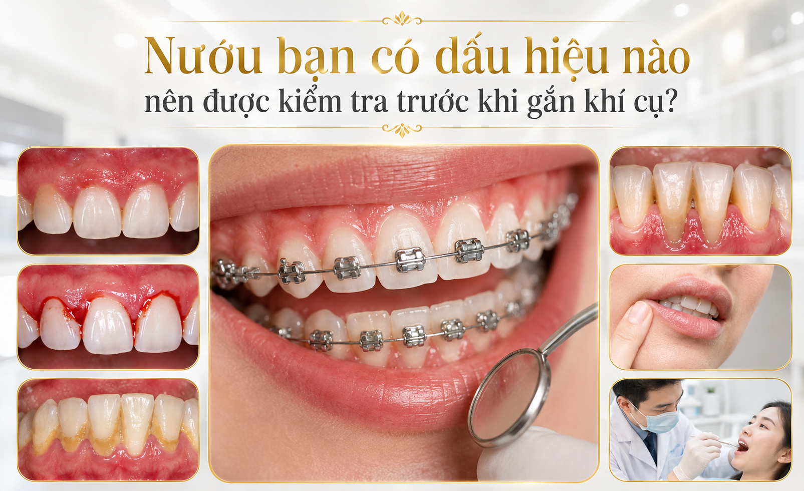 Minh họa hỗ trợ: Nướu đang viêm có nên niềng răng không?