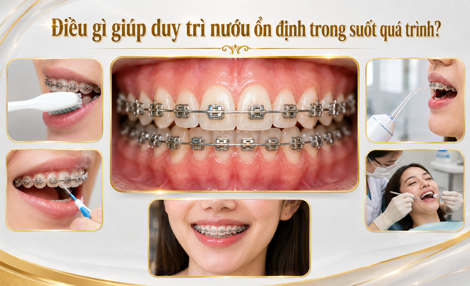 Minh họa hỗ trợ: Nướu đang viêm có nên niềng răng không?