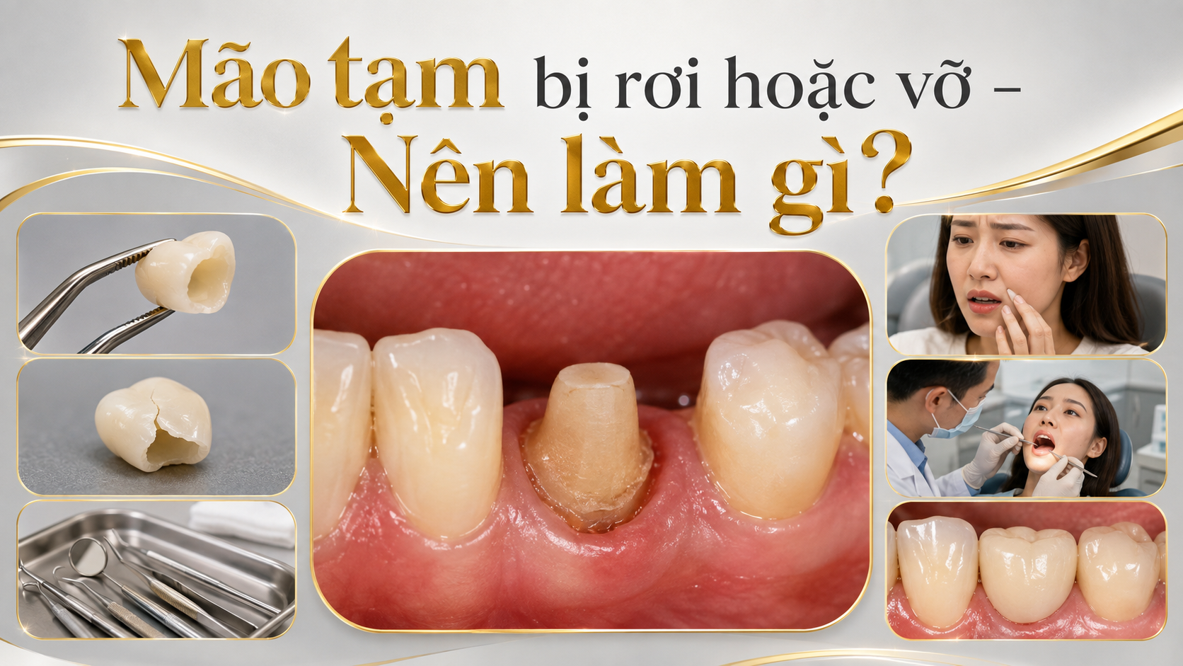 Hướng dẫn chăm sóc mão răng tạm