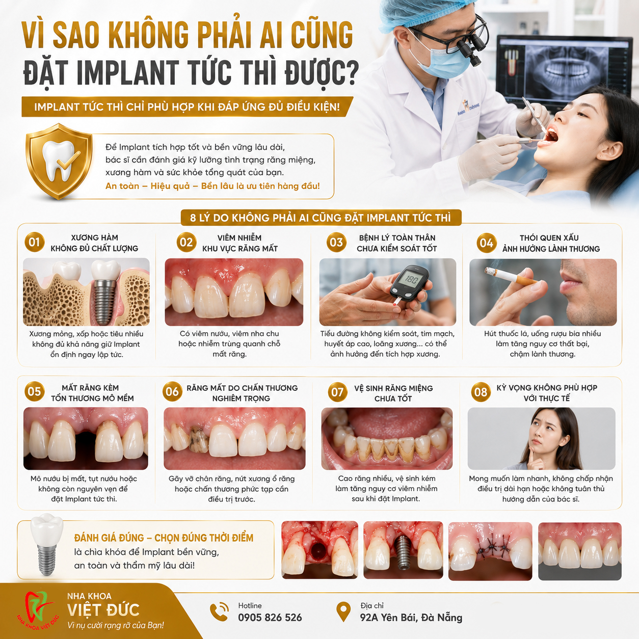 Minh họa hỗ trợ: Nhổ răng xong có đặt Implant ngay được không?