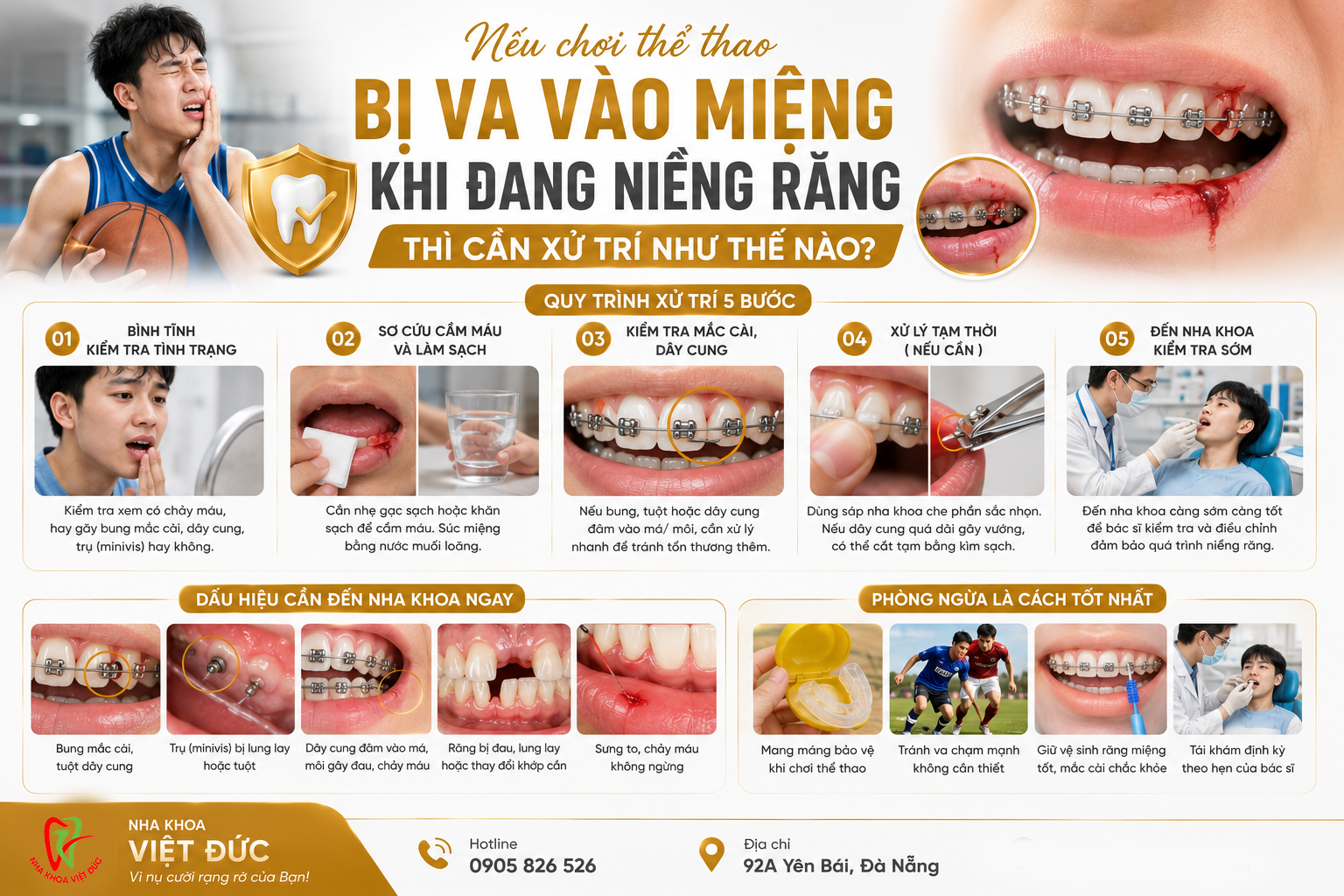 Minh họa hỗ trợ: Chơi thể thao khi niềng răng: cách bảo vệ răng và mắc cài